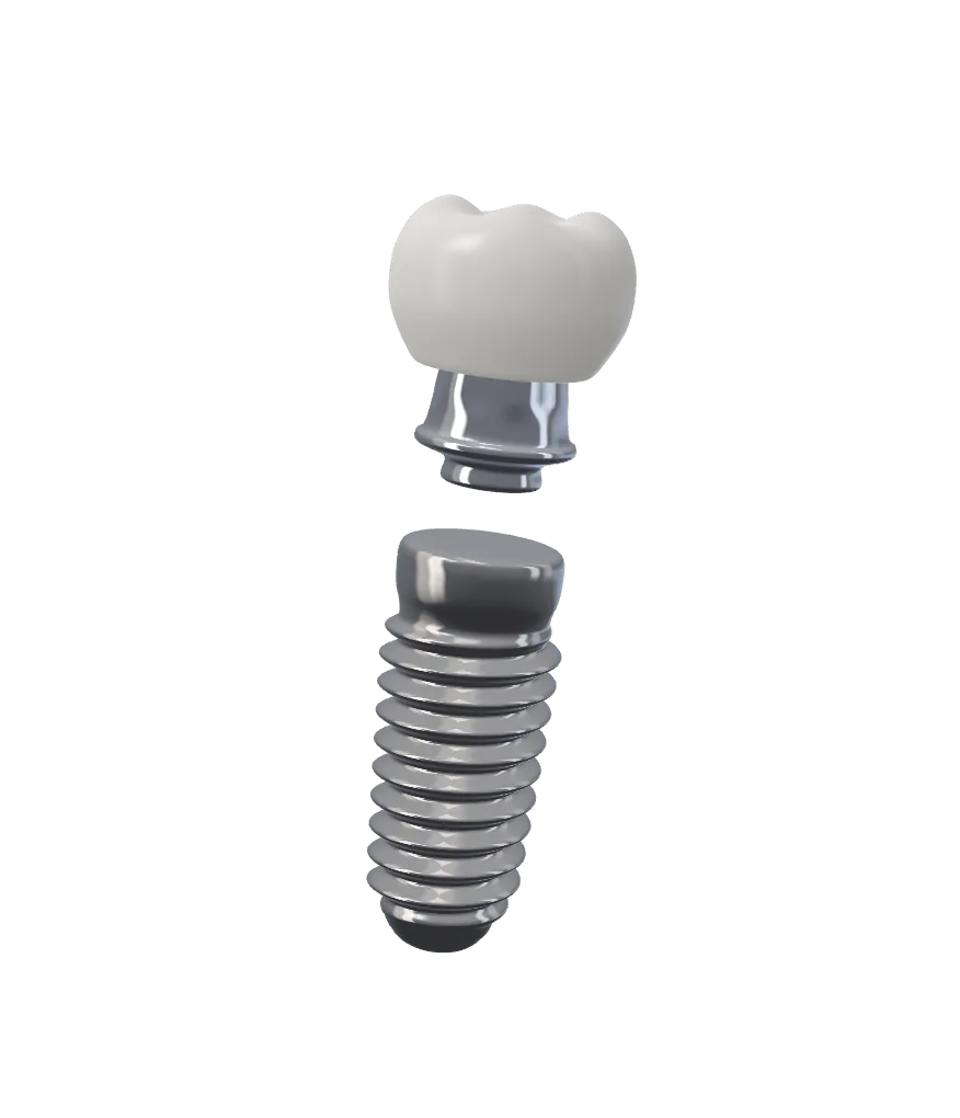 Impianto dentale in titanio con moncone e corona in ceramica